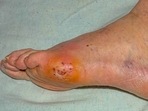 Diabetic foot treatment: Here's all you need to know about stem cell therapy (Twitter/HealthProRadio) Diabetic foot treatment: Here's all you need to know about stem cell therapy (Twitter/HealthProRadio)