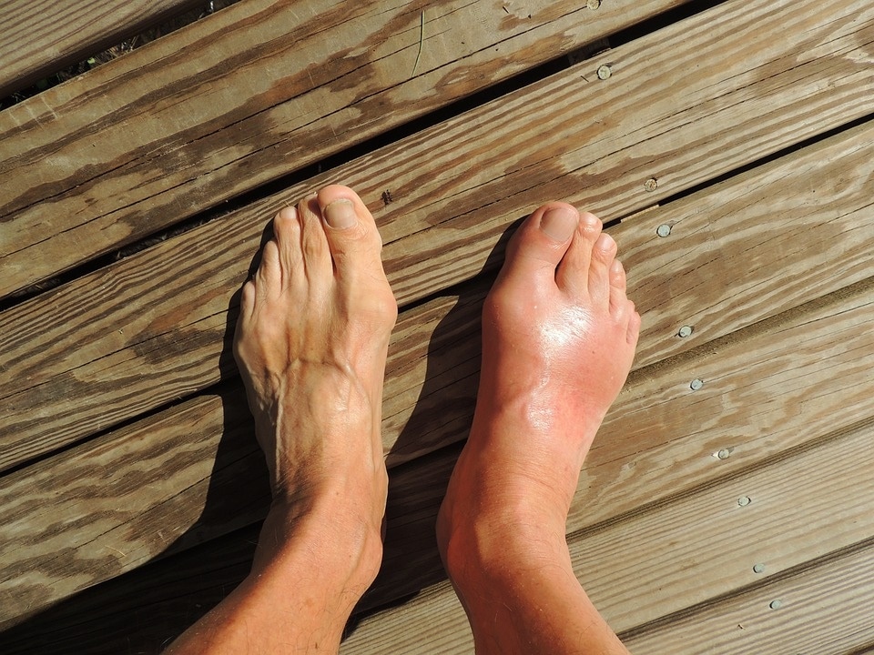 Midfoot arthritis is considered a 'wear and tear' disease because the cartilage in the joint wears down with repeated stress and use over time. (Pixabay)