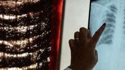 The PMC reported a total 56 deaths due to TB till the end of June this year while the Pimpri-Chinchwad Municipal Corporation (PCMC) reported a total 39 deaths owing to TB during the same time (REPRESENTATIVE PHOTO) The PMC reported a total 56 deaths due to TB till the end of June this year while the Pimpri-Chinchwad Municipal Corporation (PCMC) reported a total 39 deaths owing to TB during the same time (REPRESENTATIVE PHOTO)