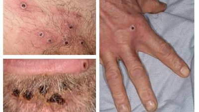 Monkeypox, a rare viral disease, occurs primarily in tropical rainforest areas of Central and West Africa, though it is occasionally exported to other regions. (AFP)