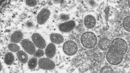 An electron microscopic (EM) image shows mature, oval-shaped monkeypox virus particles as well as crescents and spherical particles of immature virions, obtained from a clinical human skin sample associated with the 2003 prairie dog outbreak. (File image)