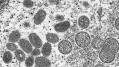 An electron microscopic (EM) image shows mature, oval-shaped monkeypox virus particles as well as crescents and spherical particles of immature virions. (Representative image/Reuters)