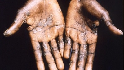 The health secretary asked all the states and union territories to take key actions to prevent the outbreak of Monkeypox. (Reuters) The health secretary asked all the states and union territories to take key actions to prevent the outbreak of Monkeypox. (Reuters)