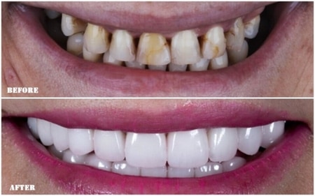 Patients who opt for Turkey teeth have a variety of options to choose from for the implanted caps, including shape, material, and colour, which, in their opinion, will result in a sparkling white Hollywood smile (Instagram)