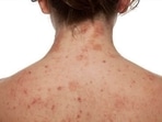 Ways to keep Dermatitis at bay: Dermats share tips(Pinterest) Ways to keep Dermatitis at bay: Dermats share tips(Pinterest)