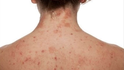 Ways to keep Dermatitis at bay: Dermats share tips (Pinterest) Ways to keep Dermatitis at bay: Dermats share tips (Pinterest)