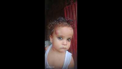A child with swollen face and multiple rashes in Faizullahganj. (HT PHOTO)