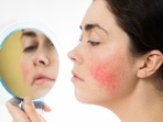 Struggling with Rosacea? Look for these ingredients in the products(Unsplash) Struggling with Rosacea? Look for these ingredients in the products(Unsplash)