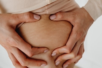 Stretch marks: 7 causes apart from pregnancy, effective ways to get rid of them (Karolina Grabowska) Stretch marks: 7 causes apart from pregnancy, effective ways to get rid of them (Karolina Grabowska)