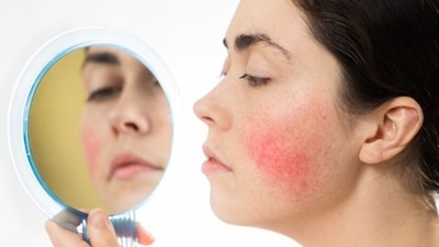 Struggling with Rosacea? Look for these ingredients in the products (Unsplash) Struggling with Rosacea? Look for these ingredients in the products (Unsplash)