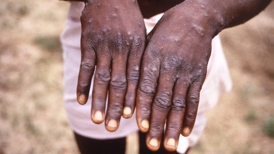 Study shows 95% monkeypox cases via sexual activity, WHO holds meet(AFP) Study shows 95% monkeypox cases via sexual activity, WHO holds meet(AFP)