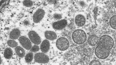 An electron microscopic (EM) image shows mature, oval-shaped monkeypox virus particles as well as crescents and spherical particles of immature virions, obtained from a clinical human skin sample associated with the 2003 prairie dog outbreak. (File image) (VIA REUTERS)