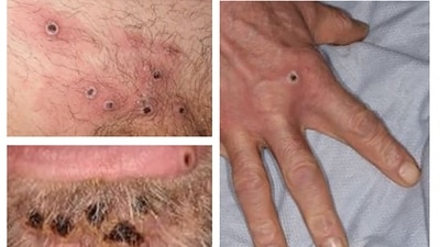 A handout picture made available by the UK Health Security Agency (UKHSA) on shows a collage of monkeypox rash lesions at an undisclosed date and location. (AFP) A handout picture made available by the UK Health Security Agency (UKHSA) on shows a collage of monkeypox rash lesions at an undisclosed date and location. (AFP)