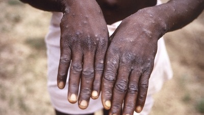 This 1997 image provided by the CDC during an investigation into an outbreak of monkeypox, which took place in the Democratic Republic of the Congo (DRC). (AP)