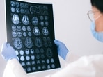 How cells are connected to brain tumor growth and recurrence: Research(Anna Shvets) How cells are connected to brain tumor growth and recurrence: Research(Anna Shvets)