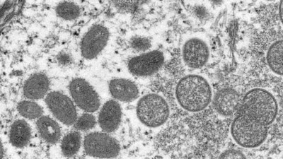 An electron microscopic (EM) image shows mature, oval-shaped monkeypox virus particles as well as crescents and spherical particles of immature virions, obtained from a clinical human skin sample associated with the 2003 prairie dog outbreak. (File image) (VIA REUTERS)