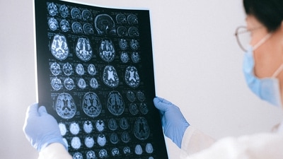 How cells are connected to brain tumor growth and recurrence: Research (Anna Shvets) How cells are connected to brain tumor growth and recurrence: Research (Anna Shvets)