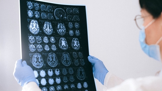 How cells are connected to brain tumor growth and recurrence: Research(Anna Shvets) How cells are connected to brain tumor growth and recurrence: Research(Anna Shvets)