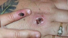 US leads globally in most known cases of monkeypox virus.
