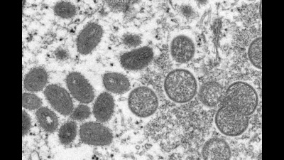 Monkeypox is a viral zoonotic disease that is mainly transmitted from animals to humans, but also spreads among humans. (AP) Monkeypox is a viral zoonotic disease that is mainly transmitted from animals to humans, but also spreads among humans. (AP)