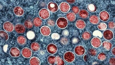 A colorised transmission electron micrograph of monkeypox shows infection particles (red) within an infected cell (blue). (AP Photo) A colorised transmission electron micrograph of monkeypox shows infection particles (red) within an infected cell (blue). (AP Photo)
