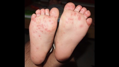 On Monday, three kindergarten students were found infected with hand, foot and mouth disease at Yadavindra Public School, Mohali.