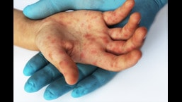A highly contagious infection, hand, foot and mouth disease is caused by viruses from the enterovirus genus, most commonly coxsackievirus. (Shutterstock)