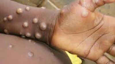 The patient, who has no travel history to a foreign country, has scabs on his hands and feet, similar to those seen in other viral ‘pox’ diseases such as chicken pox and smallpox. (Representative Image/HT File)