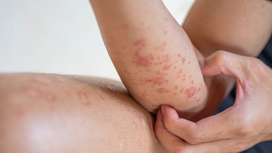 Skin infections: Bathing also helps in soothing the skin. Skipping baths lead to skin inflammation and other serious skin diseases.(Unsplash)