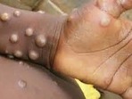 Monkeypox: Doctors debunk common myths Monkeypox: Doctors debunk common myths