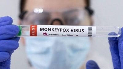 Monkeypox can cause a range of symptoms, including fever, rash, and swollen lymph nodes, which can be easily confused with symptoms of other illnesses, such as chickenpox, measles, and bacterial skin infections. (REUTERS) Monkeypox can cause a range of symptoms, including fever, rash, and swollen lymph nodes, which can be easily confused with symptoms of other illnesses, such as chickenpox, measles, and bacterial skin infections. (REUTERS)