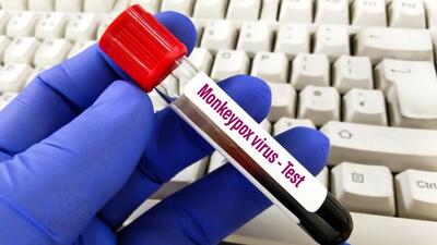 According to the state health department officials, 15 samples have tested negative for monkeypox from Maharashtra. (Shutterstock (PIC FOR REPRESENTATION))