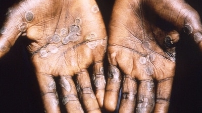 Monkeypox begins with a fever post which there are symptoms like rashes, swollen lymph nodes, headache, body ache, weakness. (Reuters) Monkeypox begins with a fever post which there are symptoms like rashes, swollen lymph nodes, headache, body ache, weakness. (Reuters)