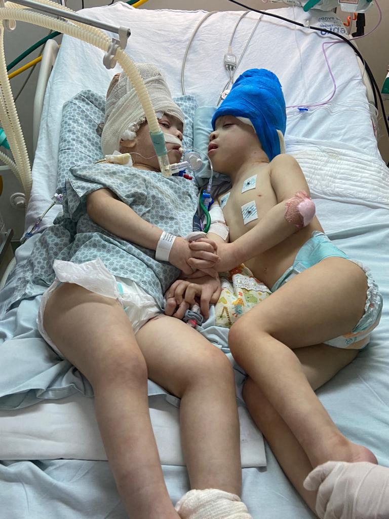 Handout photo released by Gemini Untwined shows conjoined twins Bernardo and Arthur Lima after their operation at the Instituto Estadual do Cerebro Paulo Niemeyer (IECPN) hospital in Rio de Janeiro, Brazil. (AFP) Handout photo released by Gemini Untwined shows conjoined twins Bernardo and Arthur Lima after their operation at the Instituto Estadual do Cerebro Paulo Niemeyer (IECPN) hospital in Rio de Janeiro, Brazil. (AFP)