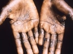 Monkeypox alert : Nine cases in India so far; 25,000 globally(Reuters) Monkeypox alert : Nine cases in India so far; 25,000 globally(Reuters)