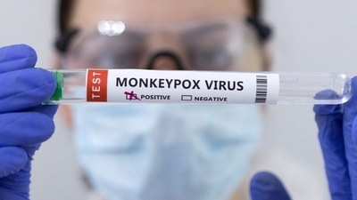 Monkeypox can cause a range of symptoms, including fever, rash, and swollen lymph nodes, which can be easily confused with symptoms of other illnesses, such as chickenpox, measles, and bacterial skin infections. (REUTERS) Monkeypox can cause a range of symptoms, including fever, rash, and swollen lymph nodes, which can be easily confused with symptoms of other illnesses, such as chickenpox, measles, and bacterial skin infections. (REUTERS)