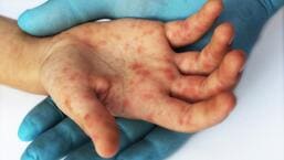 Hand, foot and mouth disease is a self-limiting disease and the infection lasts for around 7- 10 days. It can be prevented by following hand hygiene practices to break the chain of infection. (Shutterstock)