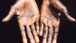 US to declare monkeypox public health emergency: Report