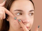 Got a pimple before the wedding? Here's how to handle pre-wedding breakout (Anna Nekrashevich) Got a pimple before the wedding? Here's how to handle pre-wedding breakout (Anna Nekrashevich)