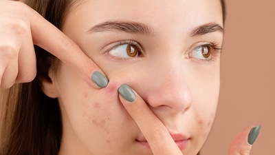Got a pimple before the wedding? Here's how to handle pre-wedding breakout (Anna Nekrashevich) Got a pimple before the wedding? Here's how to handle pre-wedding breakout (Anna Nekrashevich)