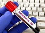According to the state health department officials, 15 samples have tested negative for monkeypox from Maharashtra. Doctors reveal how to differentiate between Monkeypox, Chickenpox and other skin rashes or infections (HT_PRINT) According to the state health department officials, 15 samples have tested negative for monkeypox from Maharashtra. Doctors reveal how to differentiate between Monkeypox, Chickenpox and other skin rashes or infections (HT_PRINT)
