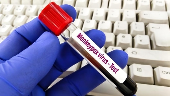 According to the state health department officials, 15 samples have tested negative for monkeypox from Maharashtra. Doctors reveal how to differentiate between Monkeypox, Chickenpox and other skin rashes or infections (HT_PRINT) According to the state health department officials, 15 samples have tested negative for monkeypox from Maharashtra. Doctors reveal how to differentiate between Monkeypox, Chickenpox and other skin rashes or infections (HT_PRINT)
