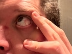Blood in the eye: Causes, types, symptoms and treatment for eye bleeding (Twitter/Jack_Froot) Blood in the eye: Causes, types, symptoms and treatment for eye bleeding (Twitter/Jack_Froot)