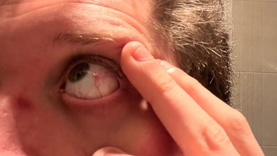 Blood in the eye: Causes, types, symptoms and treatment for eye bleeding (Twitter/Jack_Froot) Blood in the eye: Causes, types, symptoms and treatment for eye bleeding (Twitter/Jack_Froot)