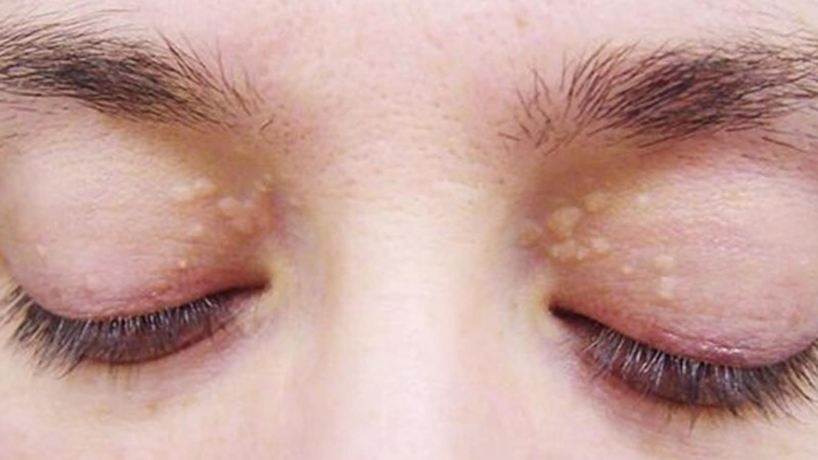 How To Remove Dark Circles Under Your Eyes  Feminain