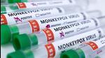 The woman’s samples returned positive for monkeypox infection on Friday, officials said. (FILE) The woman’s samples returned positive for monkeypox infection on Friday, officials said. (FILE)