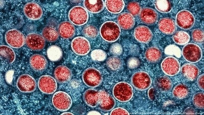 The World Health Organization has named monkeypox a global emergency, the UN body's highest level of alert. (National Institute of Allergy and Infectious Diseases/AP/picture alliance ) The World Health Organization has named monkeypox a global emergency, the UN body's highest level of alert. (National Institute of Allergy and Infectious Diseases/AP/picture alliance )