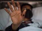 A patient shows his hand with a sore caused by an infection of the monkeypox virus in the isolation area for monkeypox patients at the Arzobispo Loayza hospital, in Lima. (AFP) A patient shows his hand with a sore caused by an infection of the monkeypox virus in the isolation area for monkeypox patients at the Arzobispo Loayza hospital, in Lima. (AFP)