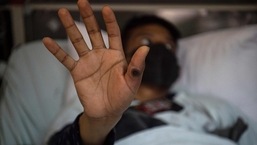 A patient shows his hand with a sore caused by an infection of the monkeypox virus in the isolation area for monkeypox patients at the Arzobispo Loayza hospital, in Lima. 