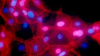 This fluorescence-colored microscope image made available by the National Institutes of Health in September 2016 shows a culture of human breast cancer cells. (AP)